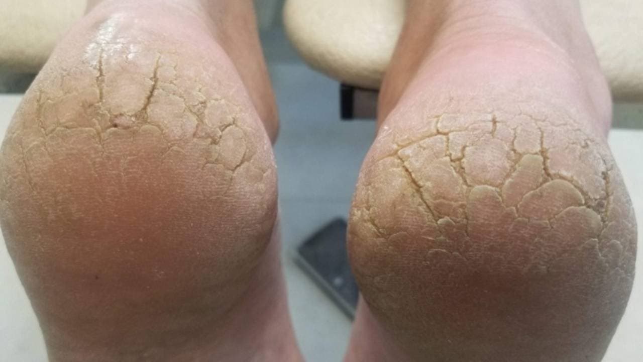 These vitamin deficiency causes cracked heels in winter