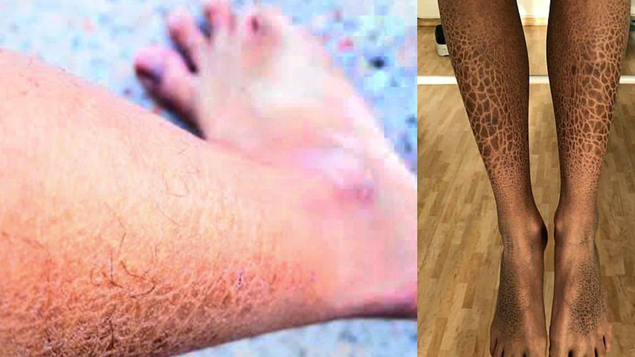 Get rid of dry skin in this winter by these 3 method