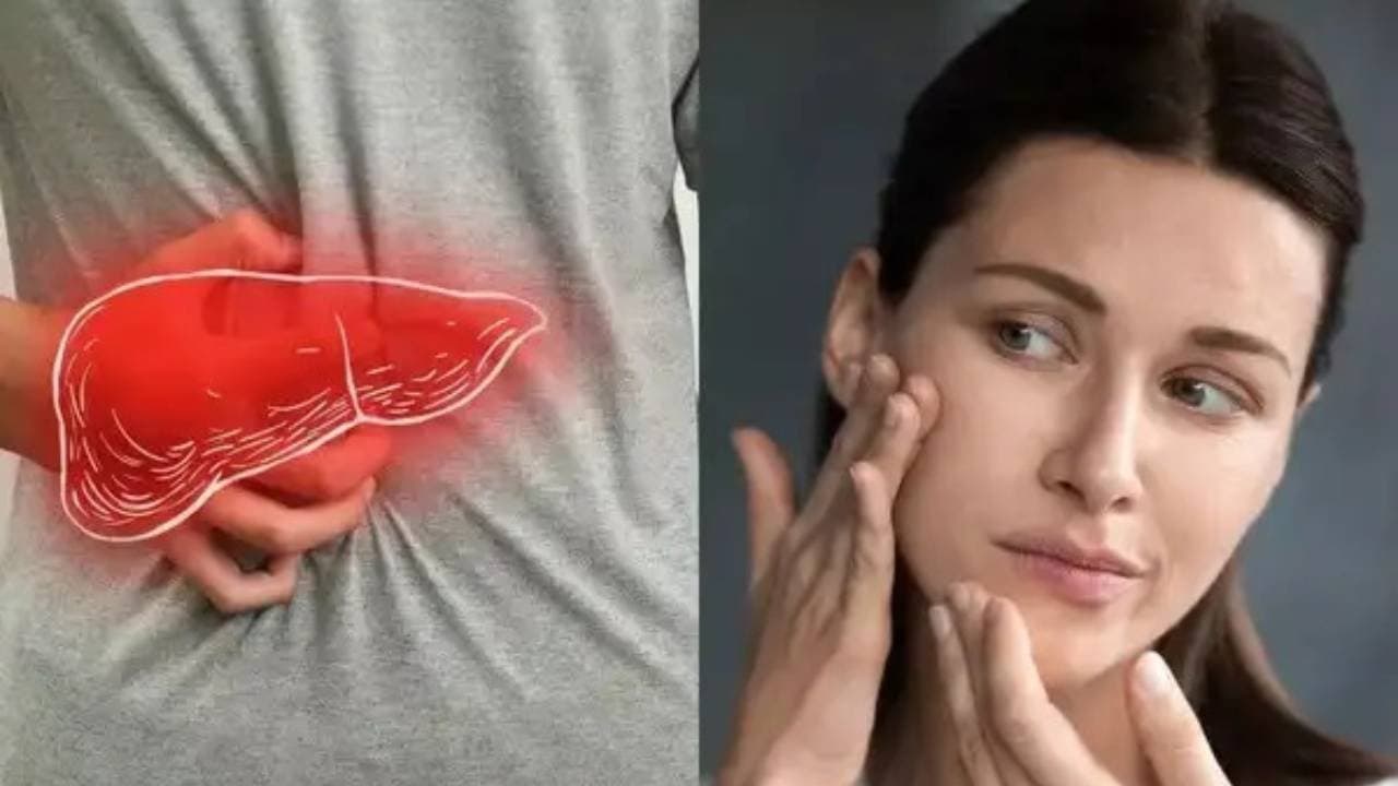 These warning signs of fatty liver appear on face should not ignore