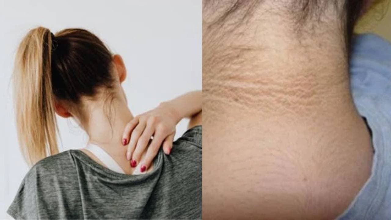 Dark Patch On Your Neck Is Likely a Serious Health Warning