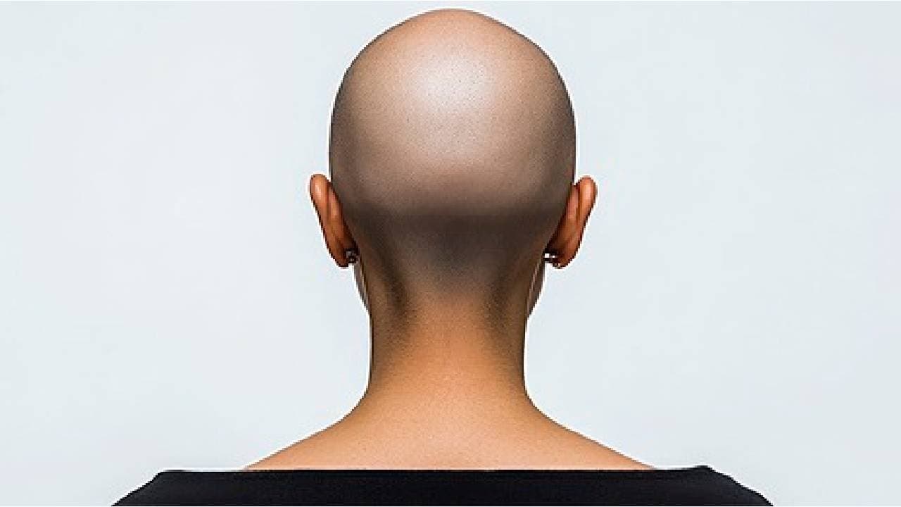 Chinese Woman Divorced Over Baldness Caused By Skin Disease