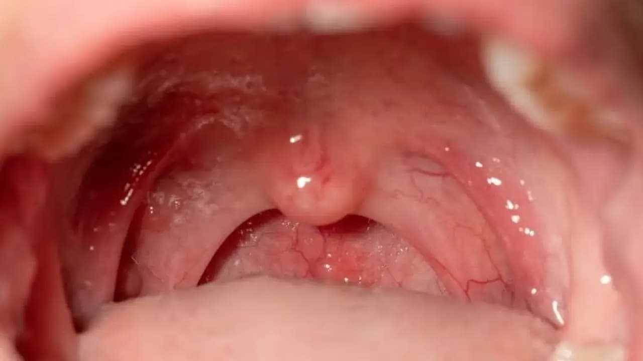 Even one glass alcohol can cause oral cancer early warning Signs 