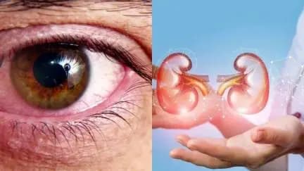 These Symptoms of eyes indicate Kidney Diseases
