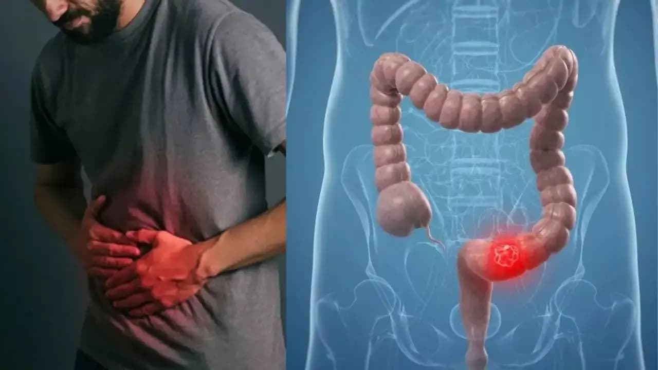 Colon Cancer prevention fruits for Gut health