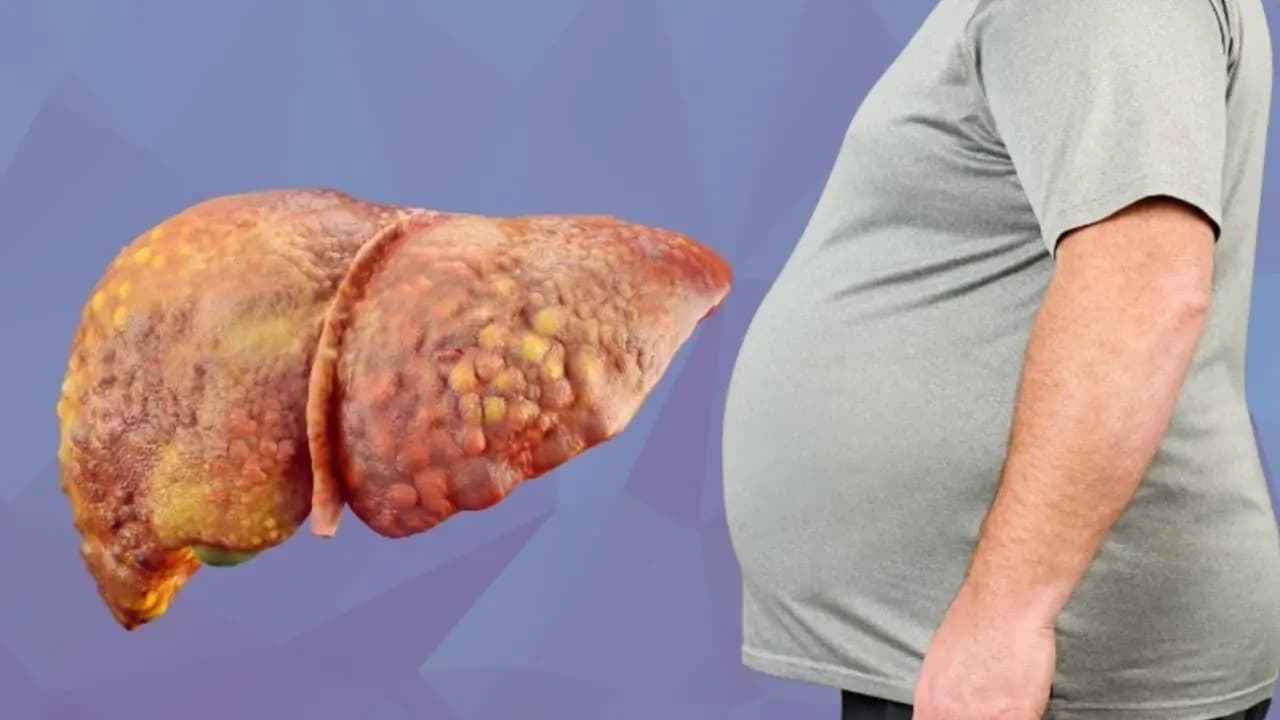Fatty Liver