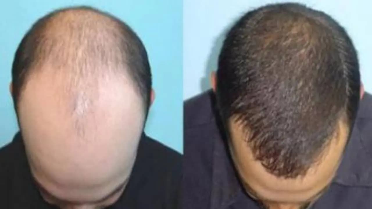 Best ancient medicinal root for hair regrowth