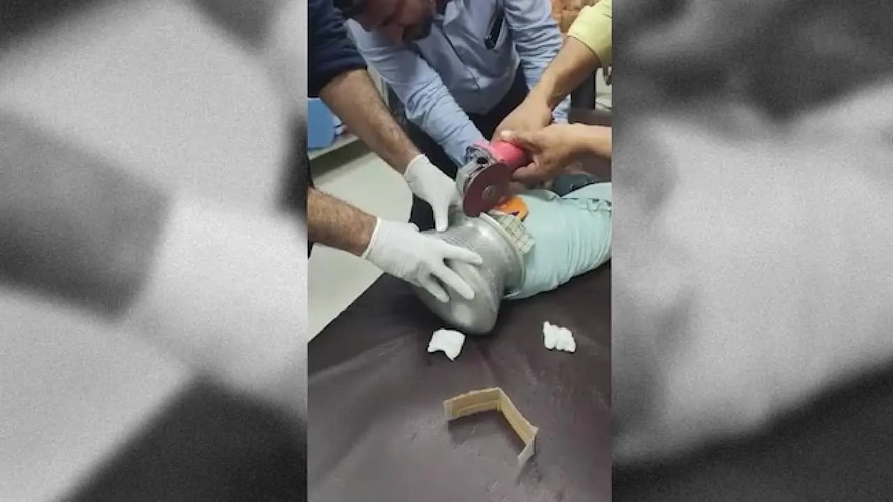 Three Year Old Boy Head Gets Stuck in Aluminium Pot Then Doctor Calls Plumber for Help In Maharashtra