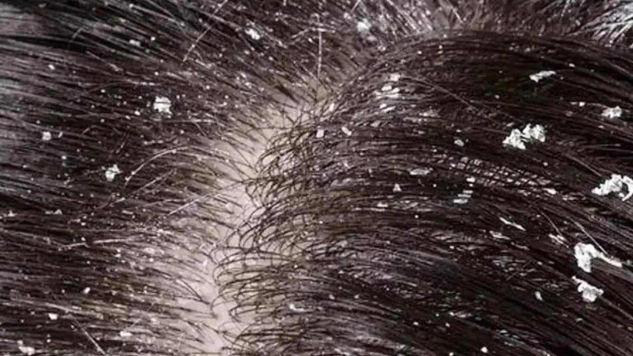 Natural Home Remedies to Prevent Winter Dandruff and Scalp Dryness