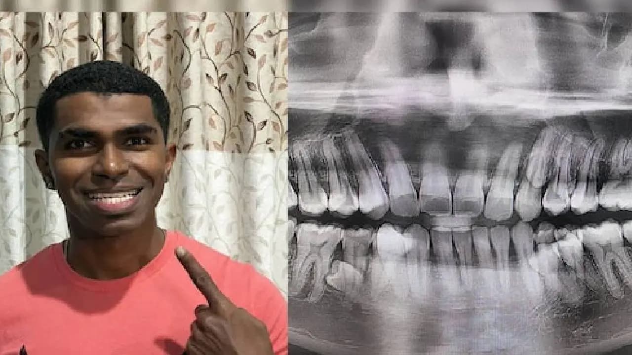 Guinness World Records: Malaysian Man With 42 Teeth Sets World Record For Most Teeth In Mouth 