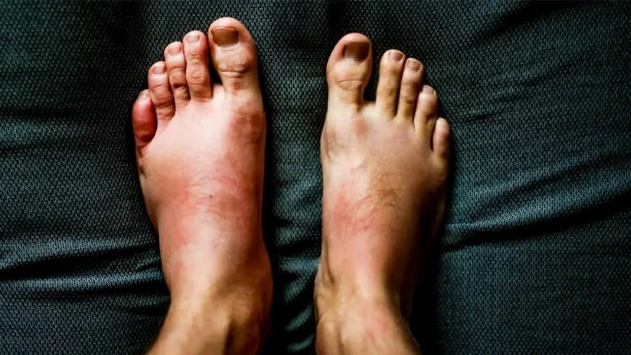Swollen Feet in the Evening? Doctors Warn It Could Signal Serious Kidney or Heart Issues