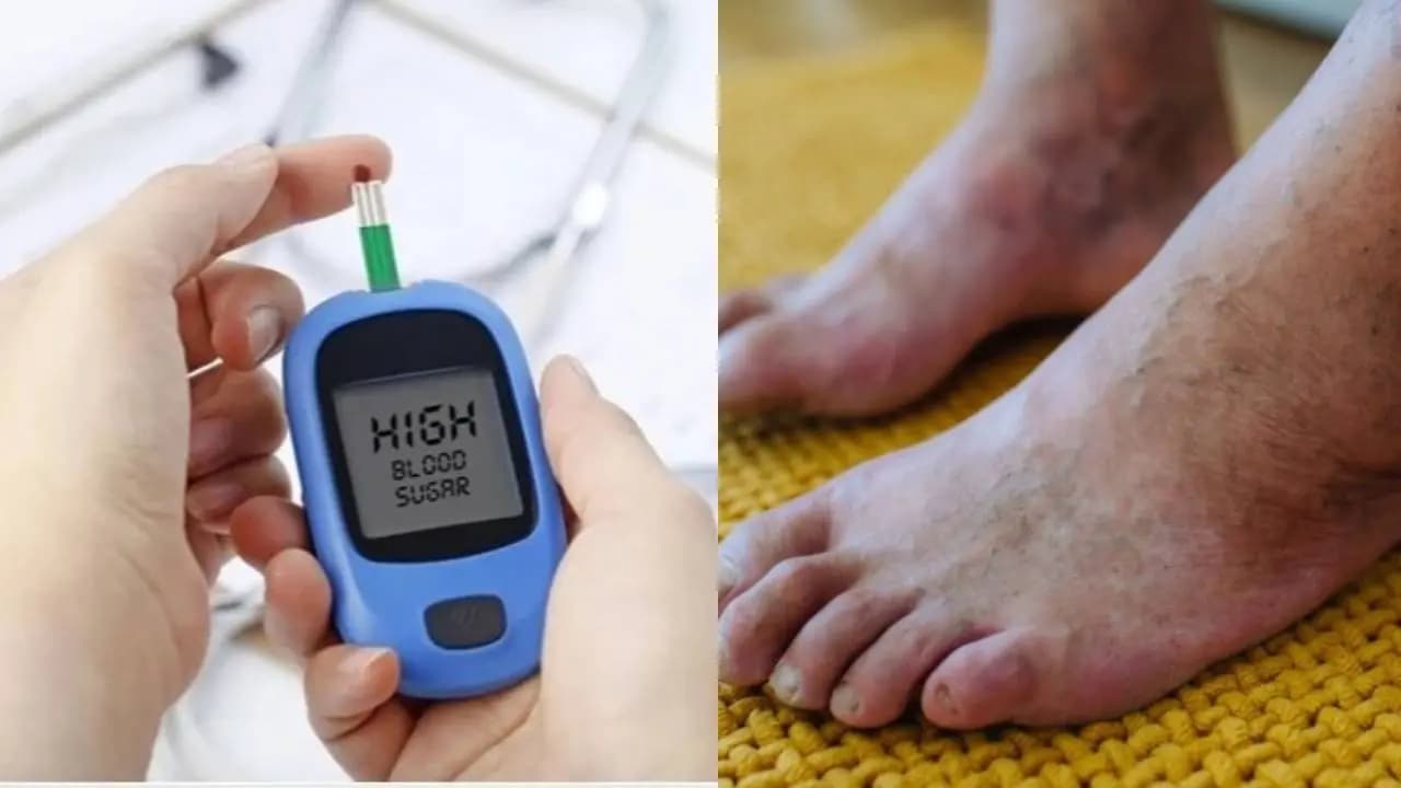 Diabetes Warning Signs: 7 Changes in Your Feet That Could Indicate High Blood Sugar Levels