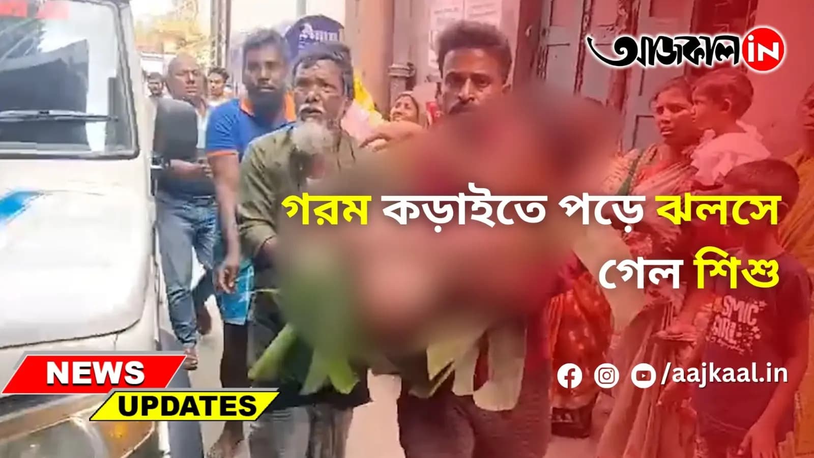 গরম কড়াইতে পড়ে ঝলসে গেল শিশু