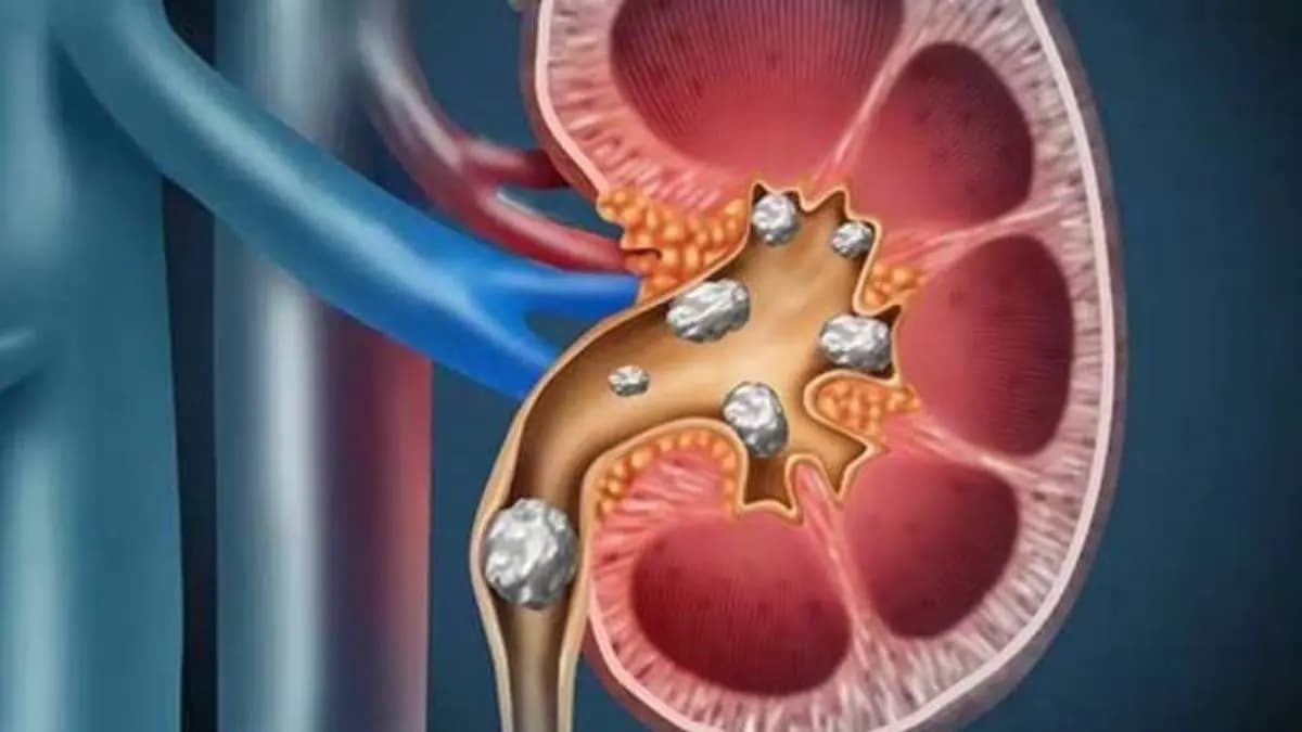 Health Tips Healthy foods that may aggravate kidney stones