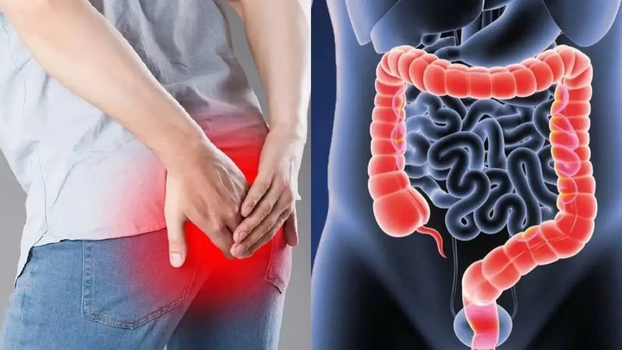 Colon Cancer Warning: 5 Silent Symptoms of Right-Sided Tumors You Should Not Ignore