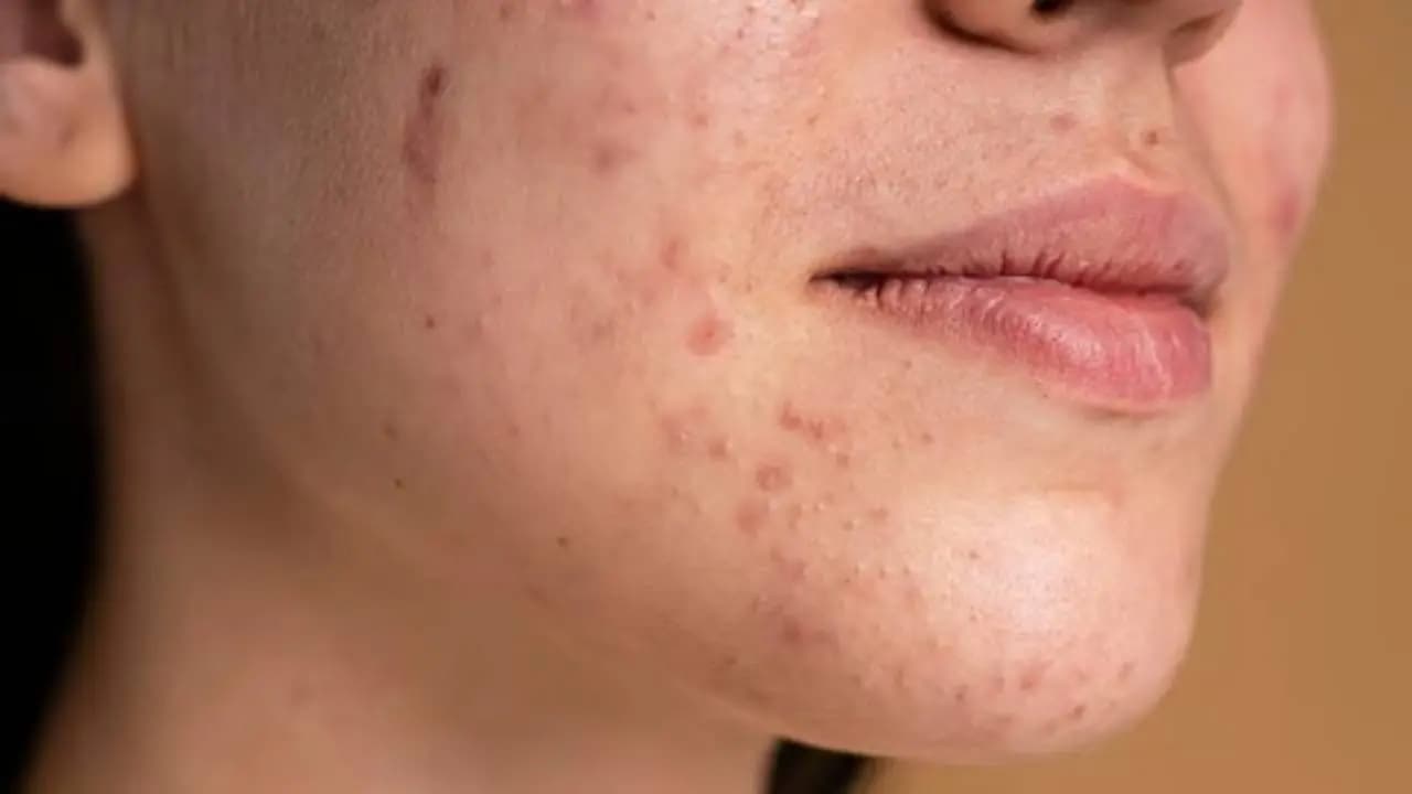 Diet for Acne-Free Skin: Expert Tips to Prevent Pimples and Improve Skin Health