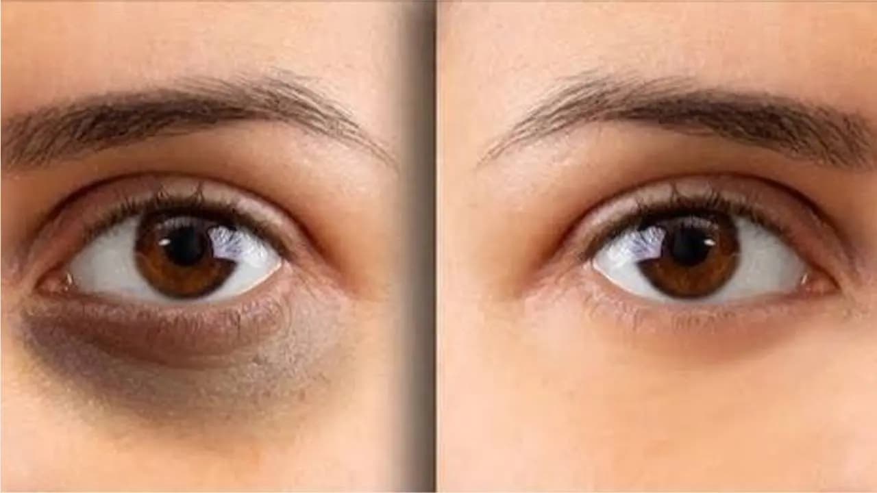 Why Dark Circles Appear: Causes Beyond Lack of Sleep and Expert Remedies for Healthy Skin