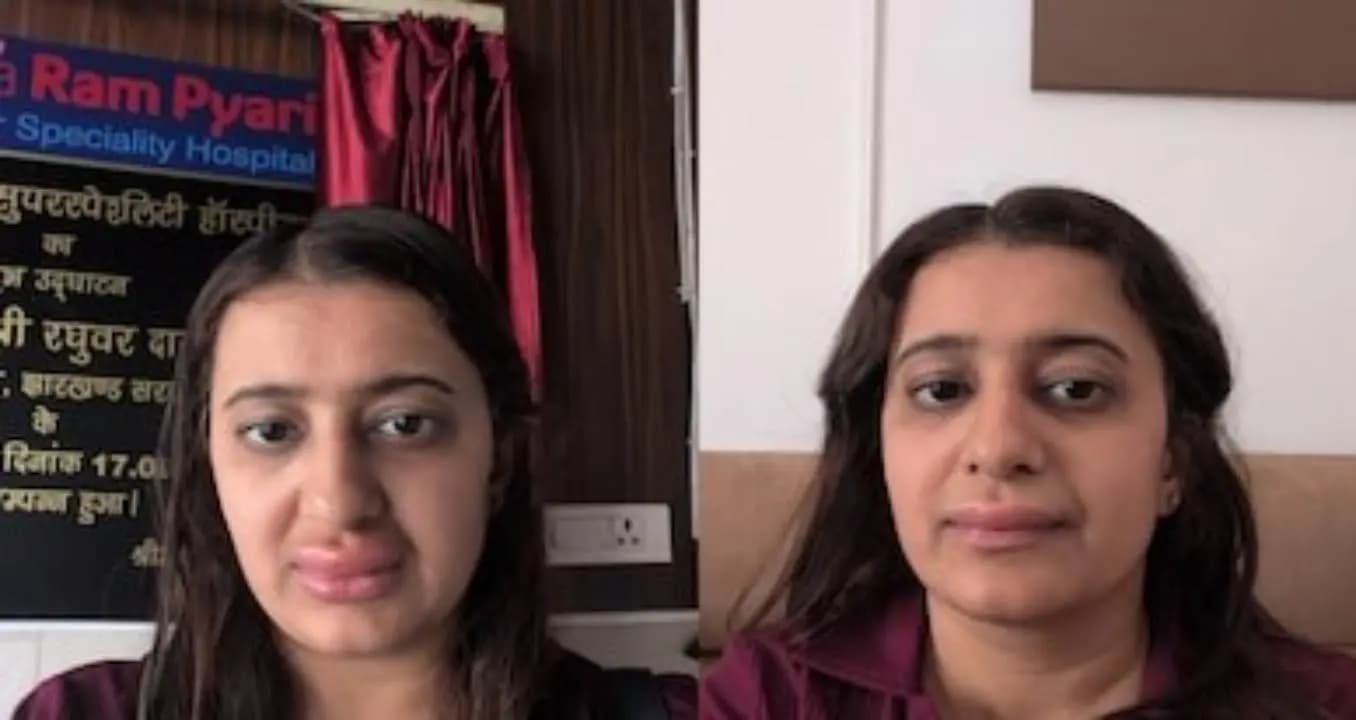 Bizarre Experience Woman Claims Food On Vande Bharat Triggered Allergy