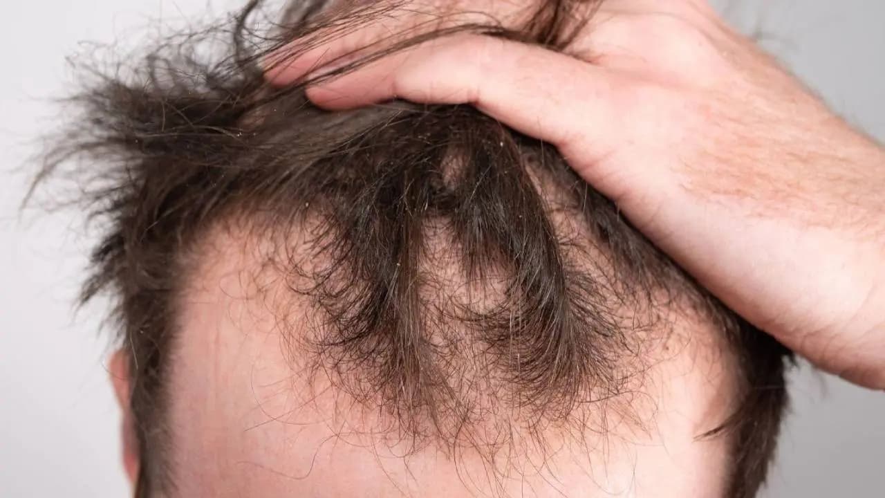 Hair Loss Warning Signs: Why Sudden Thinning Could Signal Underlying Health Issues