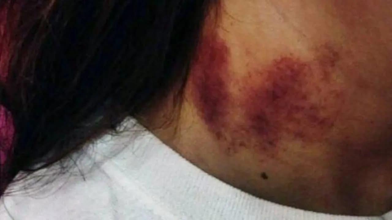 love bite takes life of a young boy in mexico city