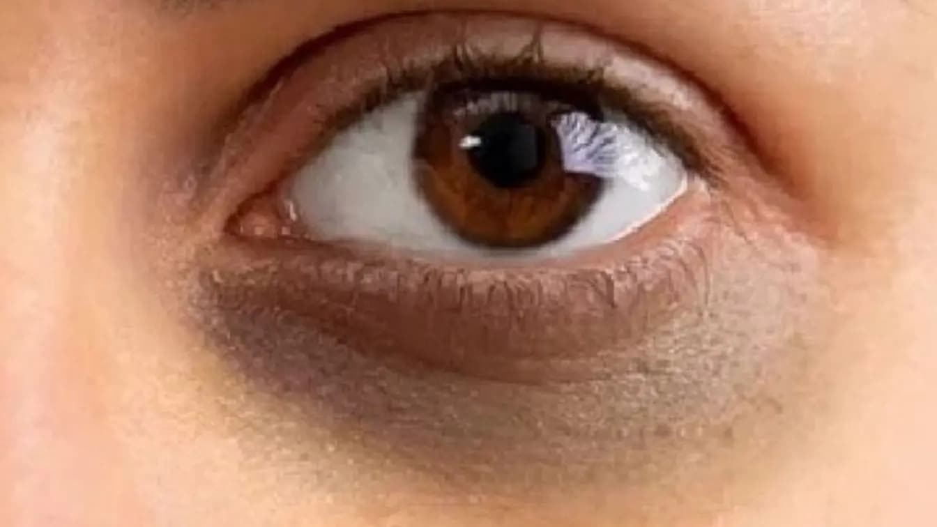 What can be the causes of dark circle even after 8 hours sleep here is actual reasons  lif