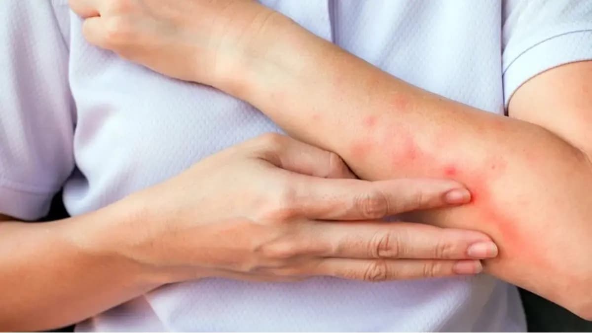Banana peels soothe itching and rashes of mosquito bite instantly