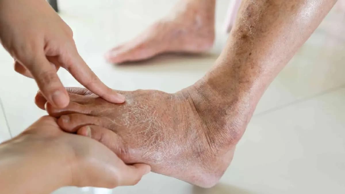 Leg symptoms of Diabetes and the treatment