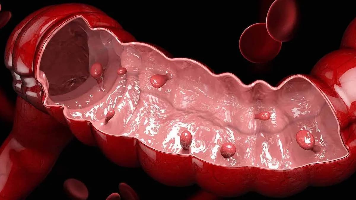 Yogurt may help to reduce Colon Cancer risk says study