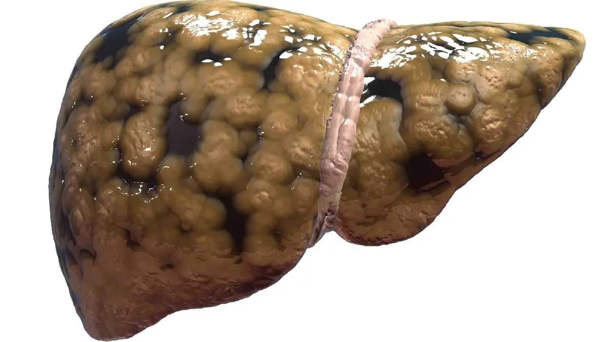 Five Daily Habits which can lead to Non Alcoholic Fatty Liver Disease