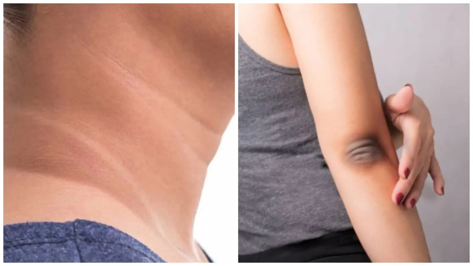 This remedies can brightening your black neck and elbow within one month lif