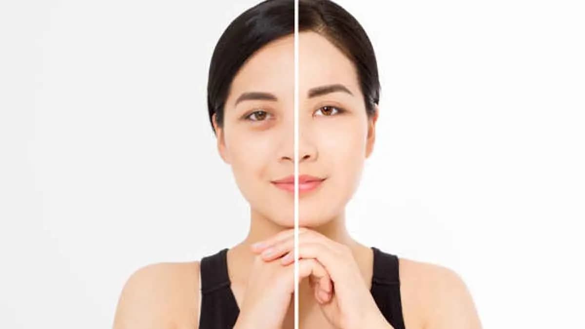 these all tricks can remove your under eye dark circles within seven days and make your eyes bright lif