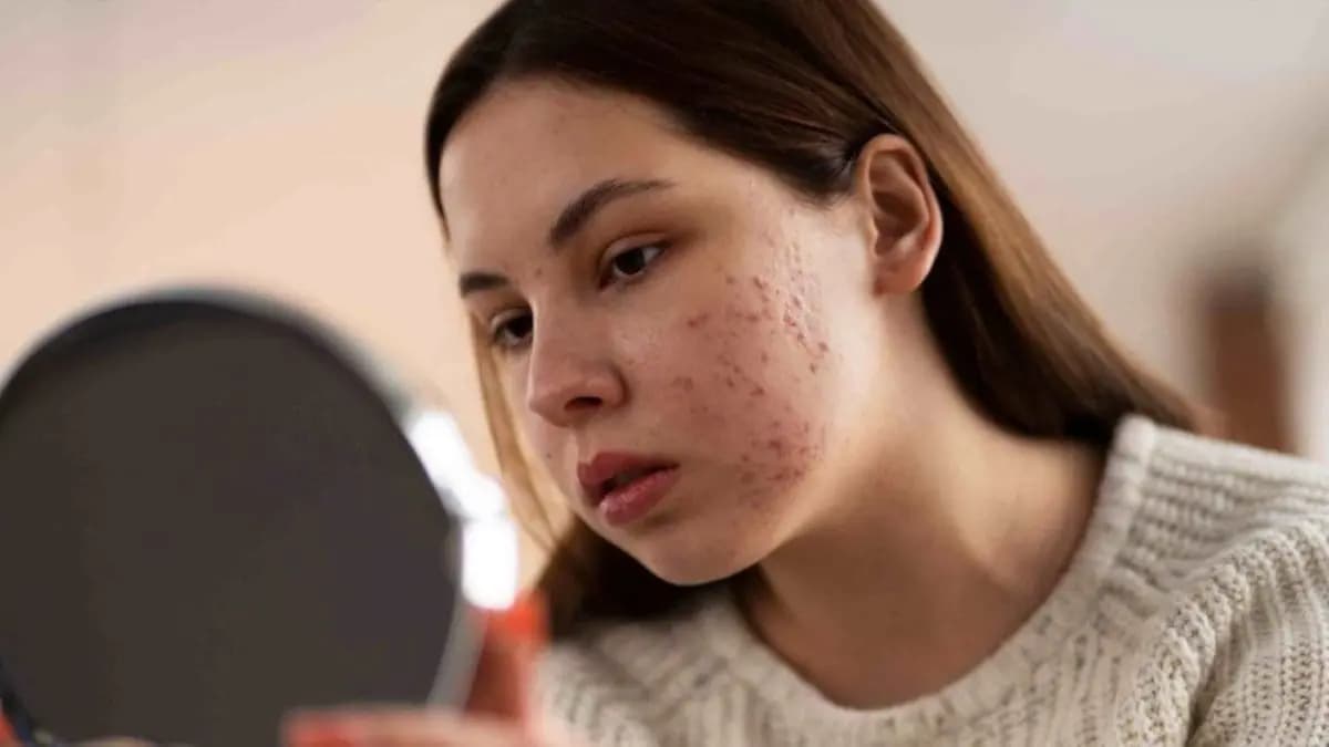these homemade face packs help to remove acne spot of face quickly know how to make it lif