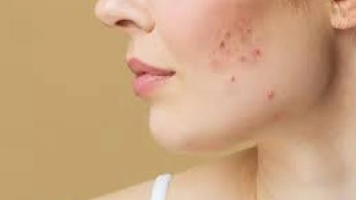  5 Things Cause Acne know the Reason Lifestyle