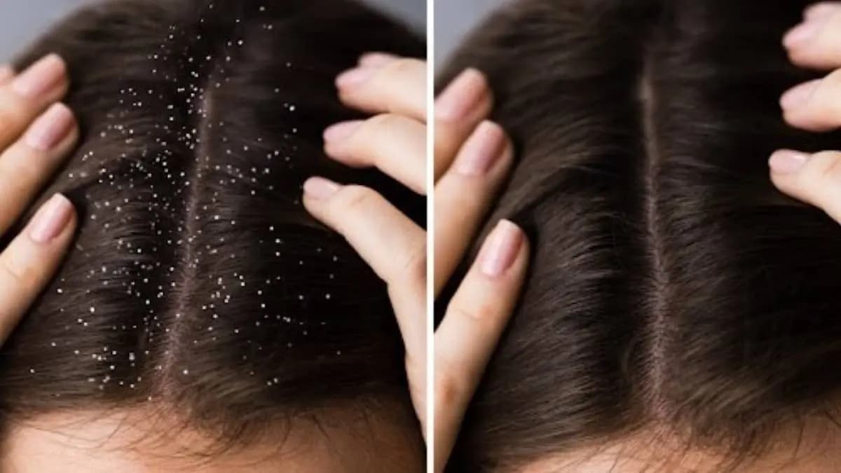 These home remedies help to prevent dandruff