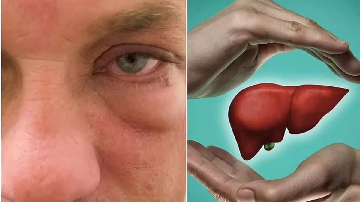 What are the symptoms of liver disease in the face