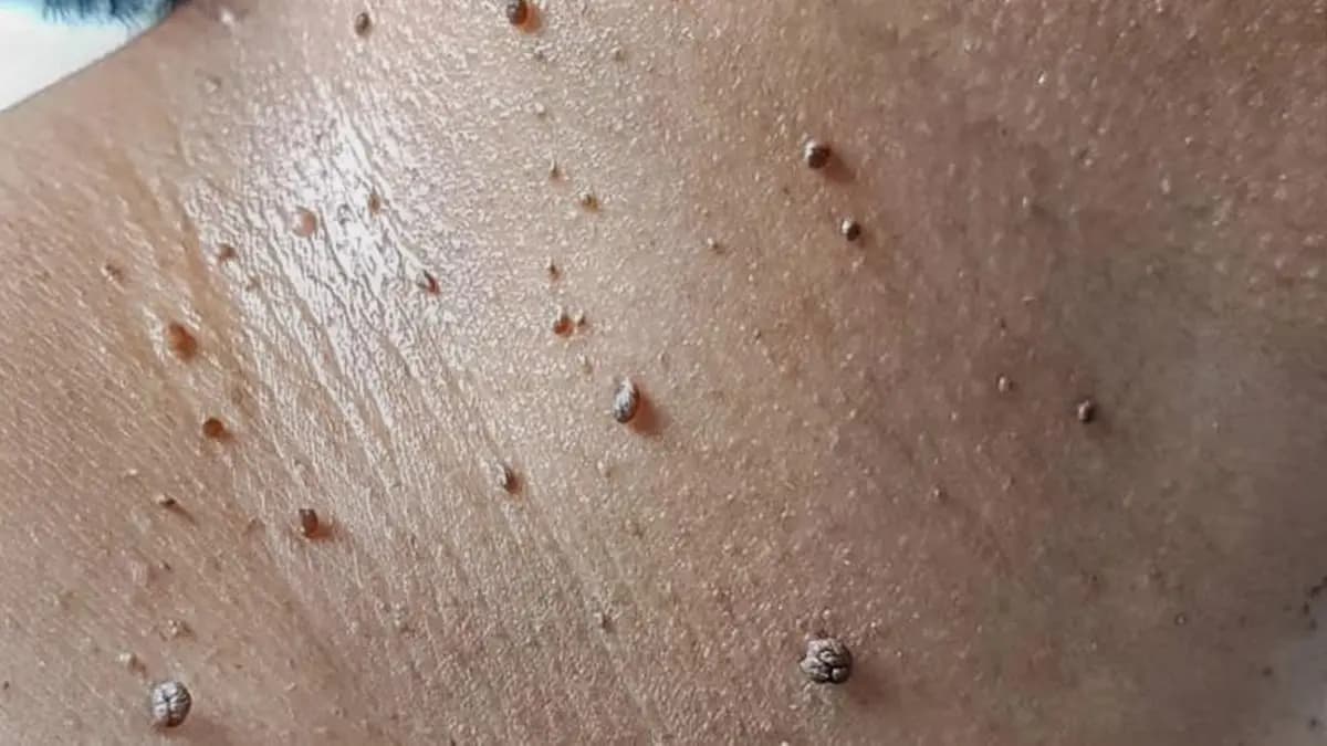 Symptoms of Skin Cancer and diagnosis