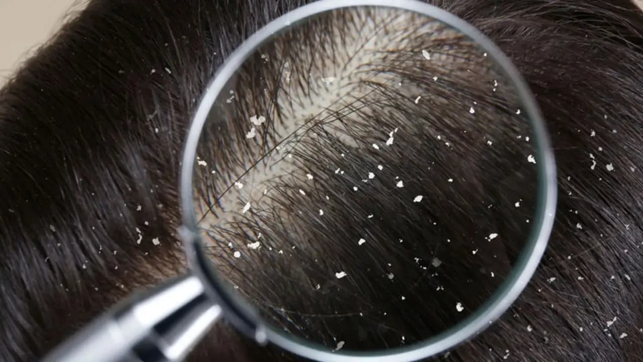 this Home made natural shampoo prevents dandruff and gives shine on hair lif