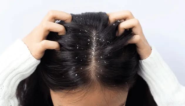 these home remedies prevent dandruff problem know all details lif