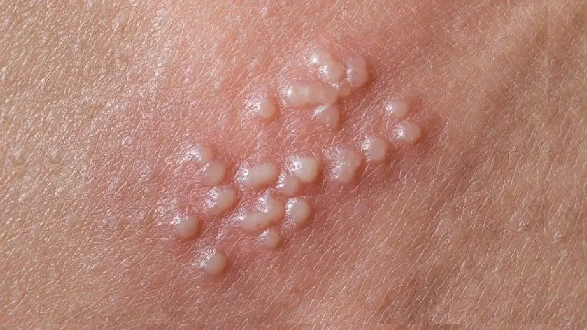 Blisters and flu among the main symptoms of Herpes