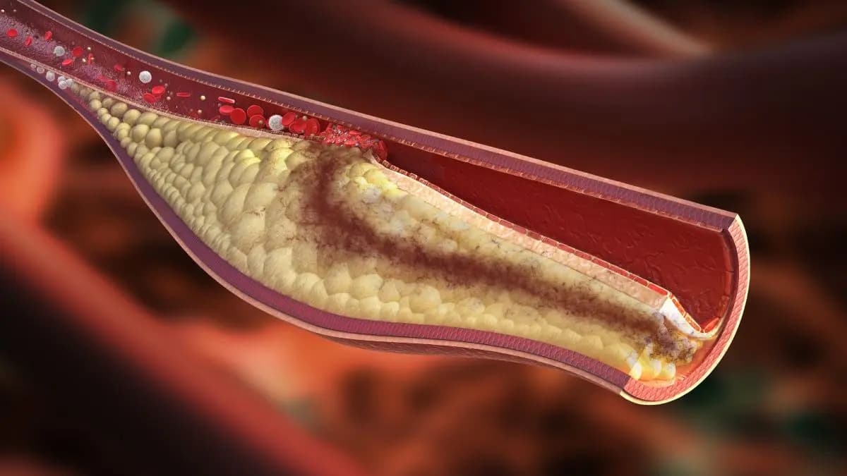 Fritters and pastry among top foods to Increase Cholesterol