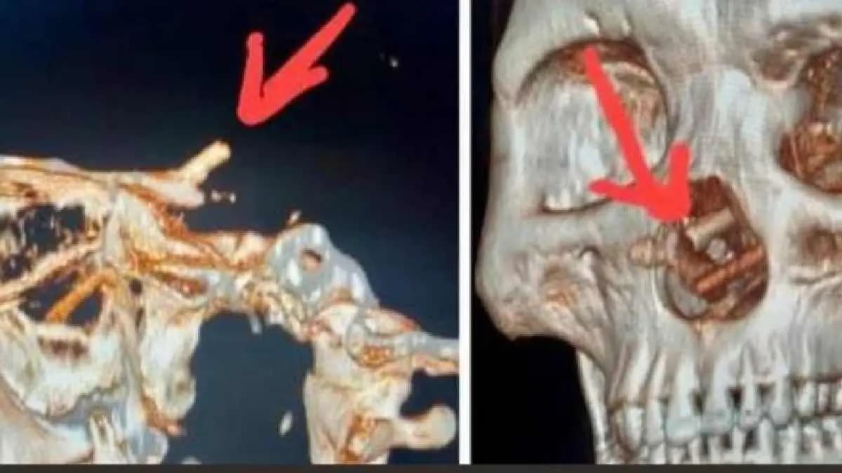  5 Month Headache Leads To Shocking report of  CT Scan