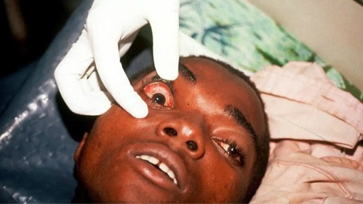 What is Marburg Virus and what are the symptoms of it