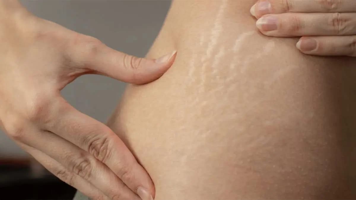  this home made natural remedy can prevent strech marks and make your skin tone tighten lif 