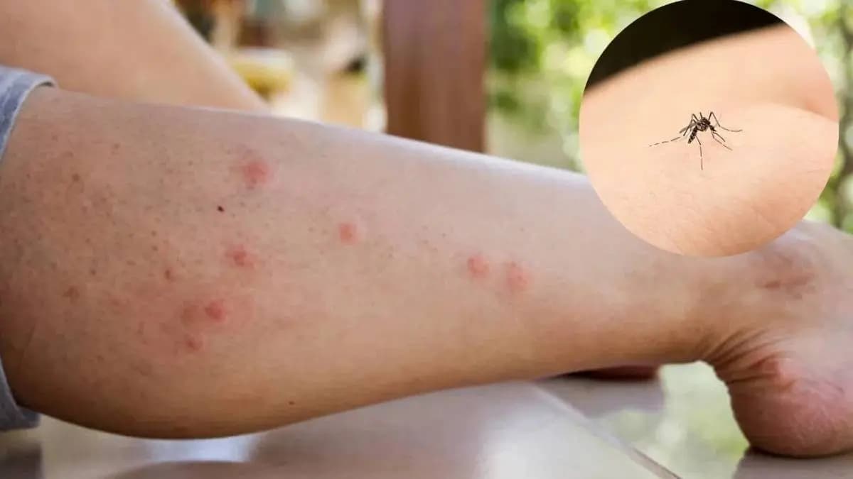 Hot spoon can relieve iching for mosquiti bite