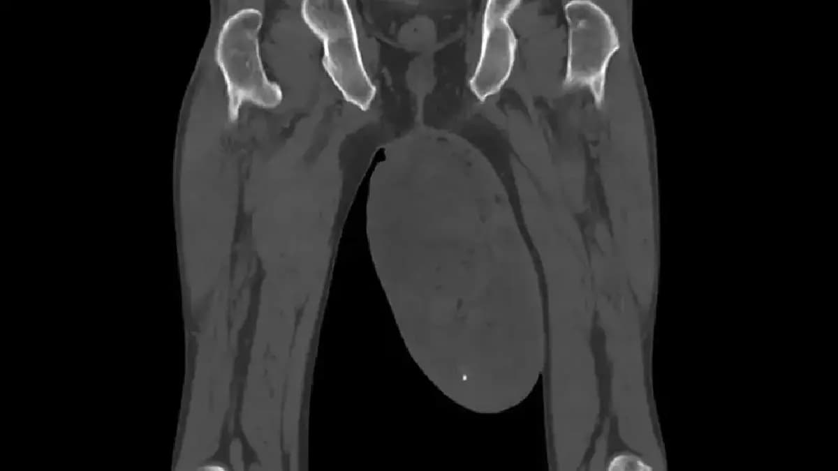 Patient suffering from Rare Medical Condition goes through Urology Operation