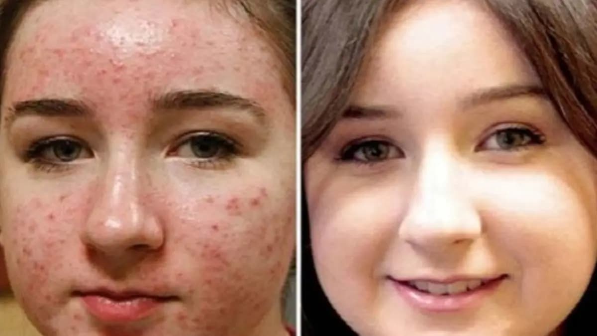these 5 homemade face packs work like magic to reduce acne problem of face details inside lif