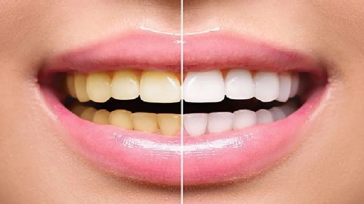 These home remedies help to whiten your teeth naturally