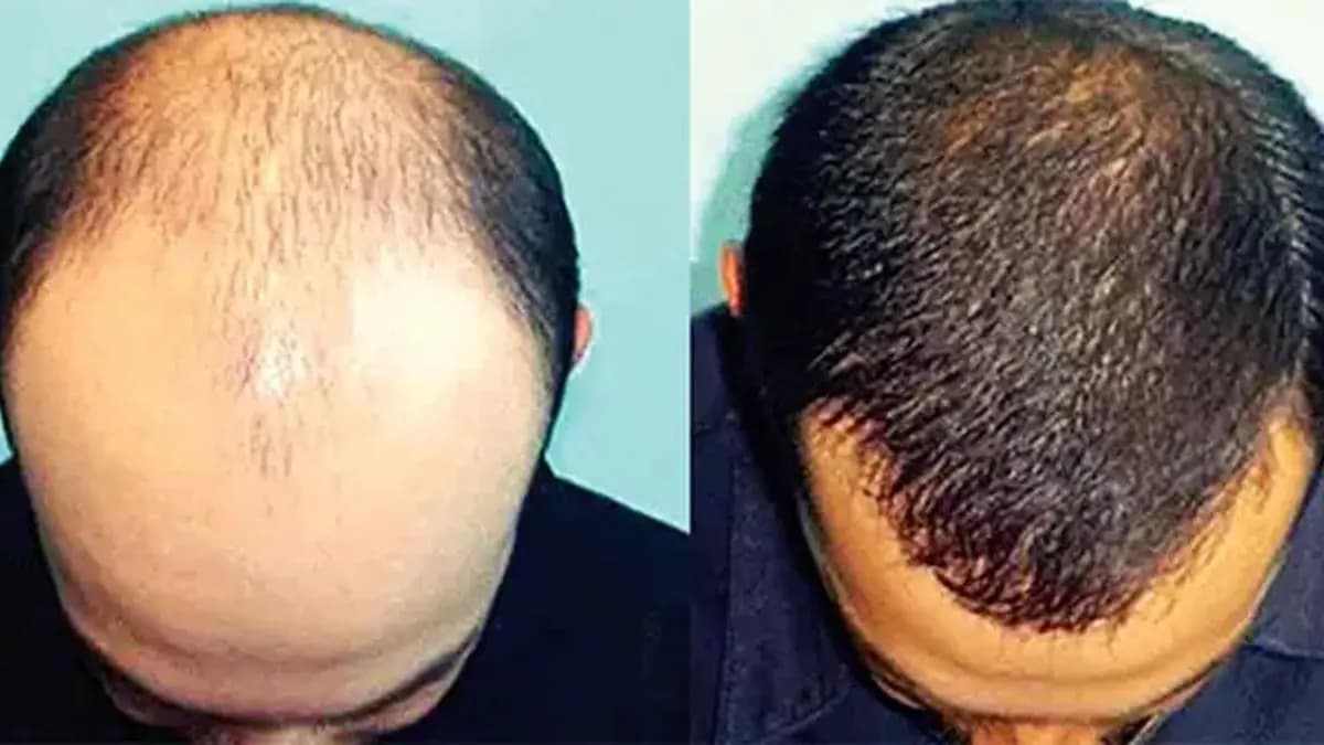 This home made oil helps to grow new hair and stop hair fall problem within seven days  