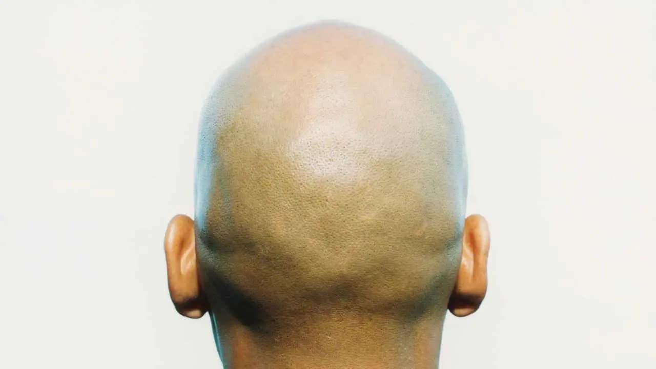 Bald Within A Week Mass Hair Loss In 3 Maharashtra Villages Sparks Panic gnr 