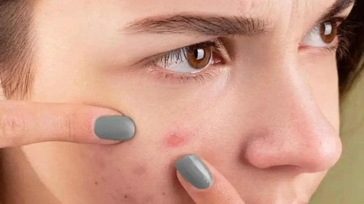 These skincare tips reduce pimples instantly and help to get flawless skin during summer 