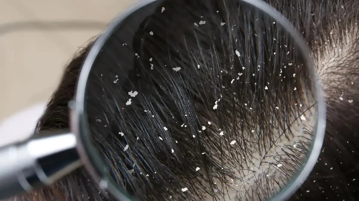 Three home remedies to clean hair dandruff in summer